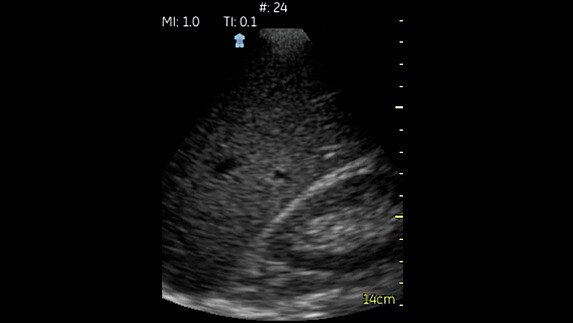 hotspot tours-vscan-hepatorenal-space_jpg