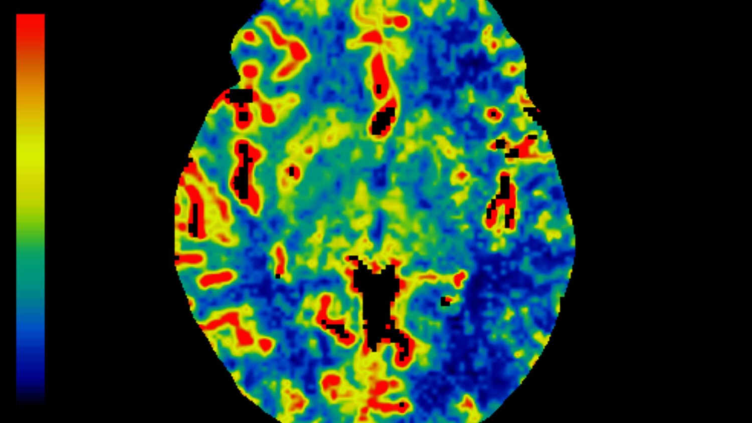 visualização avançada de tc no perfusion 4d.